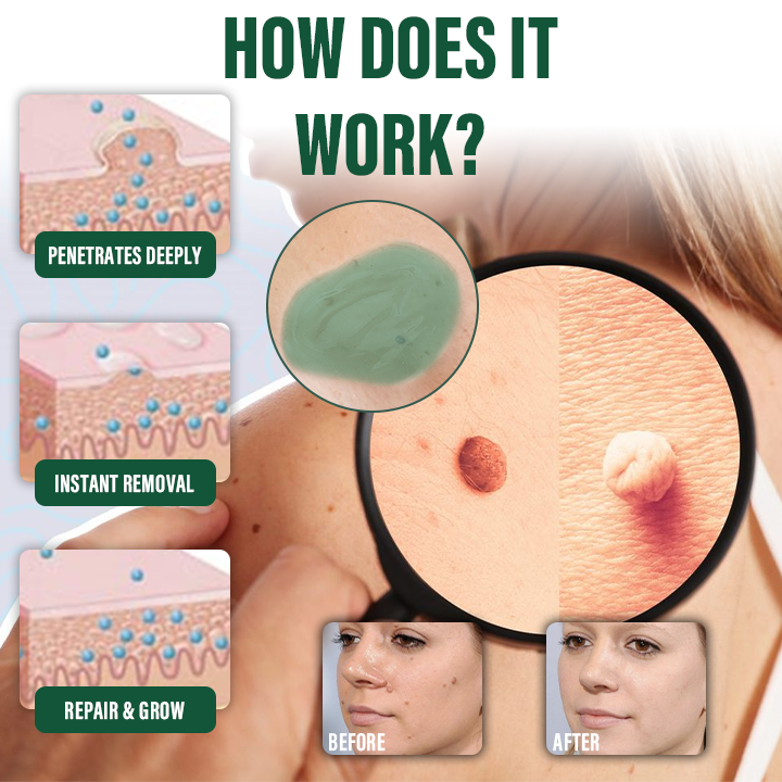 Ceoerty® DermaErase Instant Mole & Spot Remover Gel